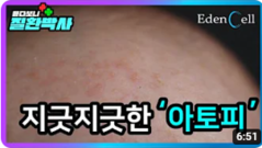 지긋지긋한 '아토피